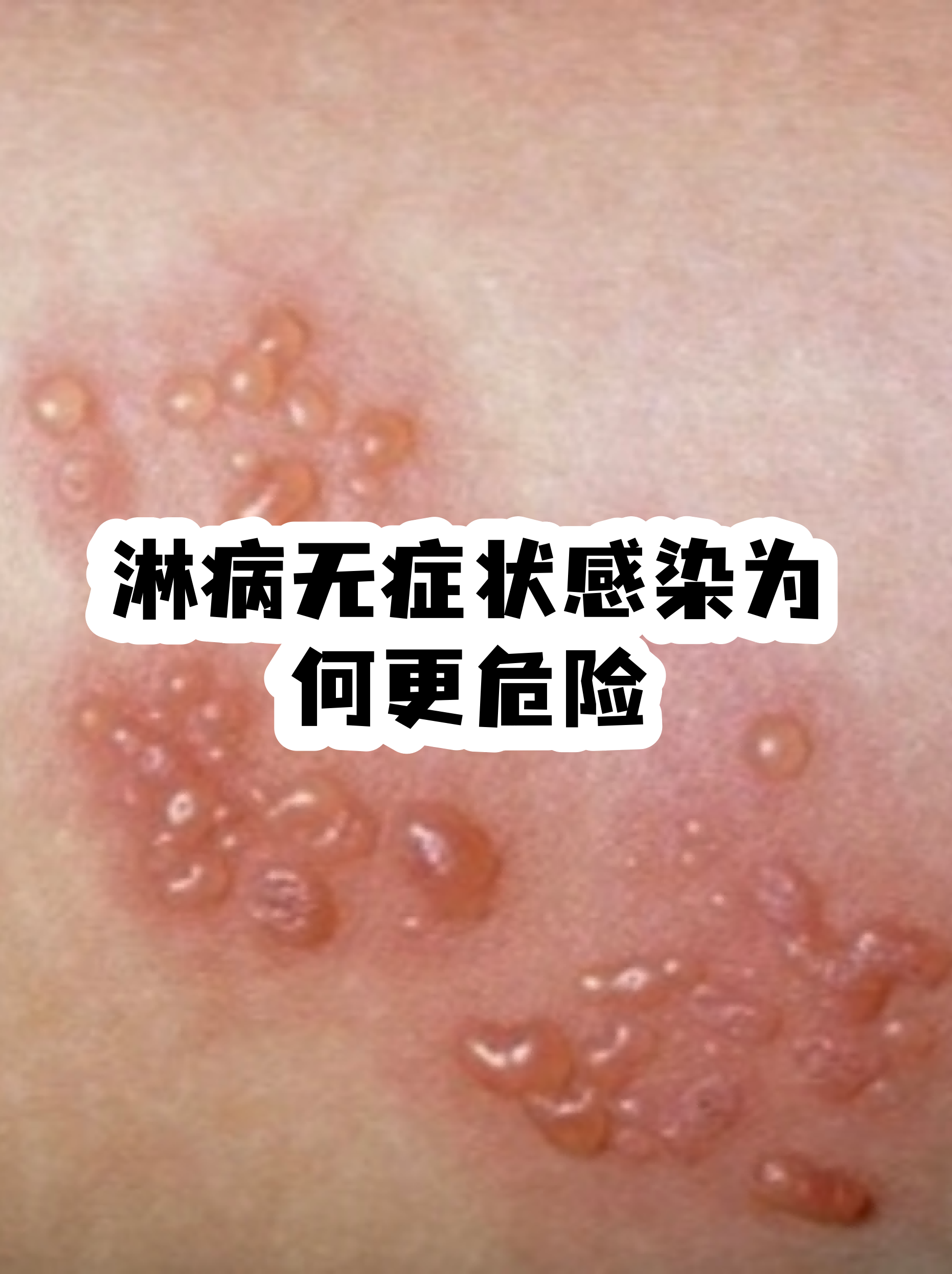 本轮疫情无症状感染者为何这么多?-为什么全是无症状感染者-第3张图片