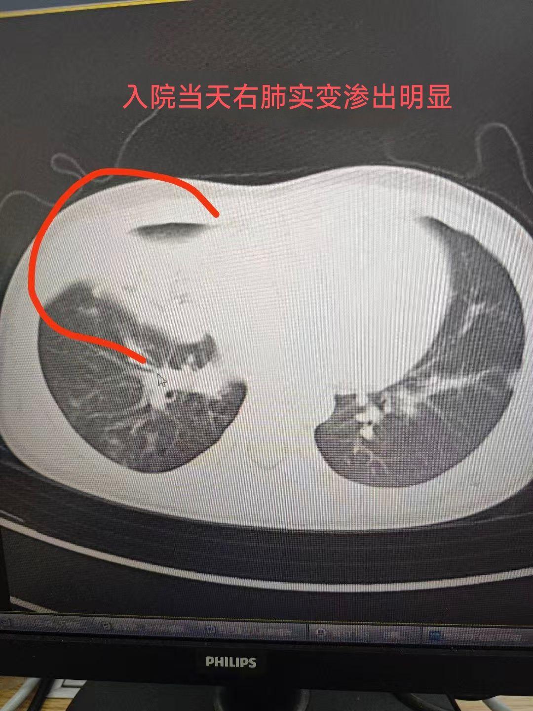 “张家口新型肺炎	” 河北省张家口市新型肺炎？-第2张图片